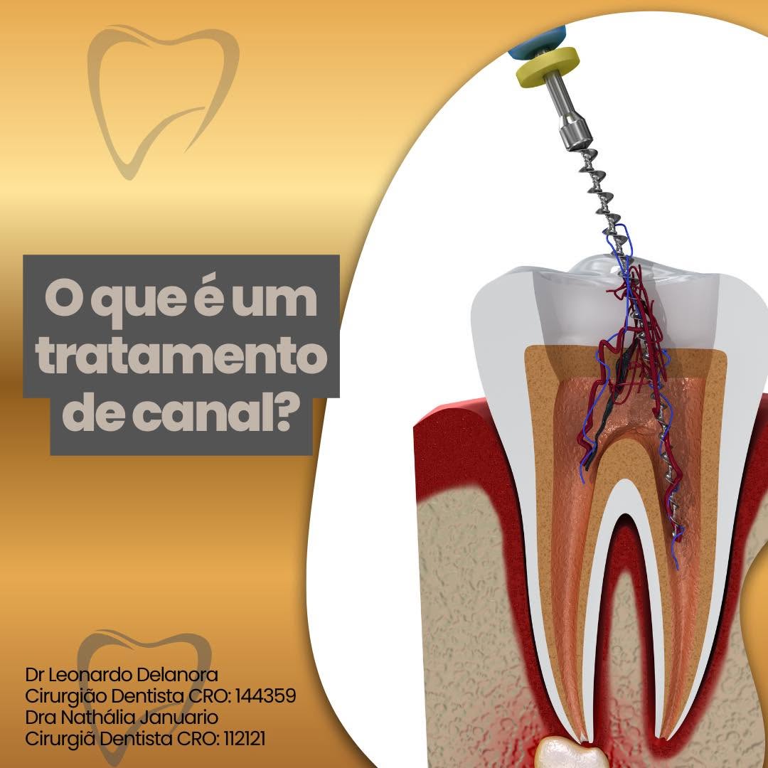 Tratamento de canal